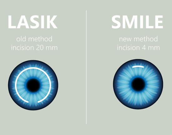 LASIK VS SMILE. 激光矯視手術的分別